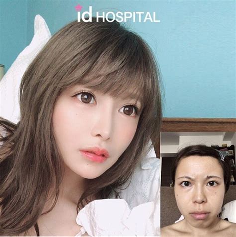 Dramatic Plastic Surgery Makeover For A Japanese Model Plastic Surgery Japanese Plastic