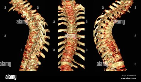 Thoracic Spine Ct Scan