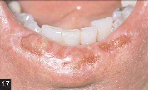 Oral Cancer And Precancerous Lesions Neville 2002 Ca A Cancer
