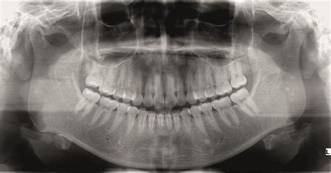 Which of the following is the nasal polyps. Nasal Polyps - Total Health Dental Center