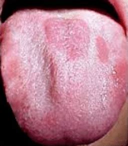 Smooth, glossy appearing tongue on a pink or red background; Red Spots on Tongue, Small, Dots, Tip, Back, How to Get ...