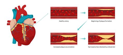 Atherosclerosis Causes And Risk Factors • Hri