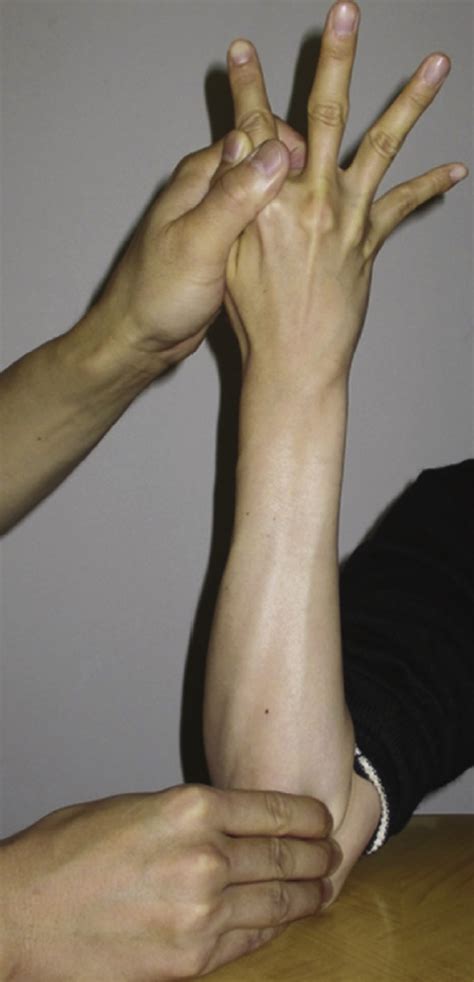 Extensor Carpi Ulnaris Subluxation Hand Clinics
