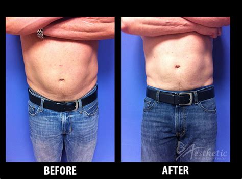 Sculpsure Results Front Aesthetic Skin And Laser Center