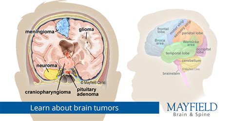 Brain Tumors Overview Of Types Diagnosis Treatment Options