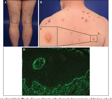 Figure 1 From Bullous Pemphigoid Developing Upon Immune Checkpoint