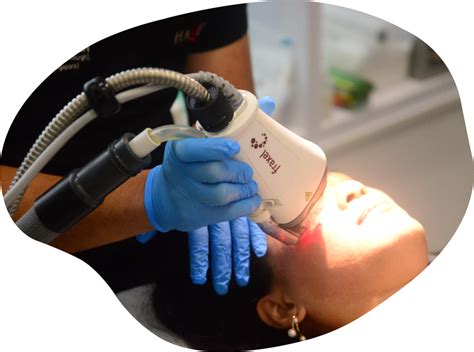 Laser Skin Resurfacing Halley Medical Aesthetics Singapore