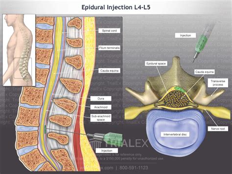Epidural Injection L4 5 Trialexhibits Inc