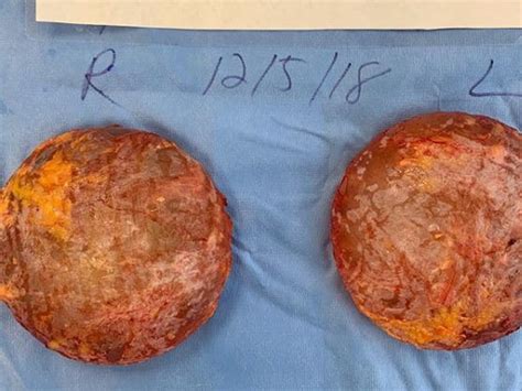 Signs or symptoms of complications must be present and documented. What breast implants look like after they've been removed