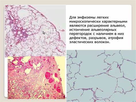 Эмфизема легких диета Эмфизема легких - презентация онлайн Эмфизема легких - презентация онлайн Эмфизема легких диета