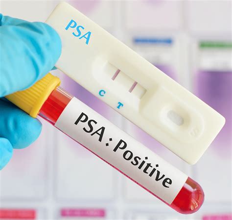 PSA Testing Wellman Clinic Prostatae Cancer Bill Turnbull