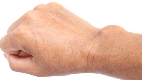 What Is A Ganglion Cyst And Other Common Questions Uchicago Medicine