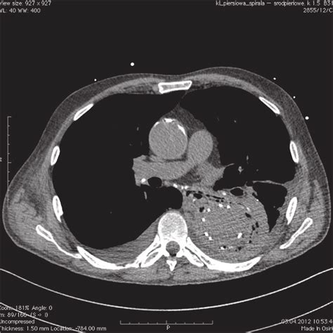 Axial Unenhanced Mediastinal Ct Air Propageting Towards Esophagus