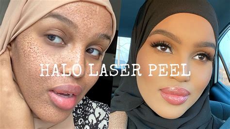 Halo Laser Peel Before And After Darker Skin Youtube
