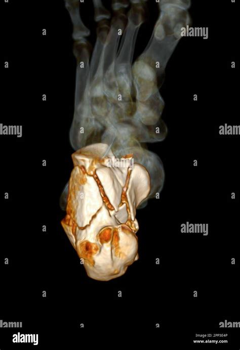 CT Scan Ankle Joint With 3d Rendering Of Calcaneus Bone Showing