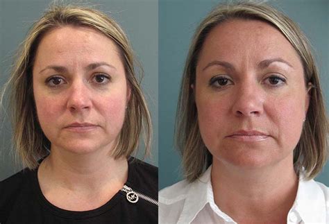 Laser Vascular Before And After Savannah Facial Plastic Surgery
