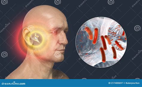 Otitis Media Inflammatory Disease Of The Middle Ear 3d Illustration