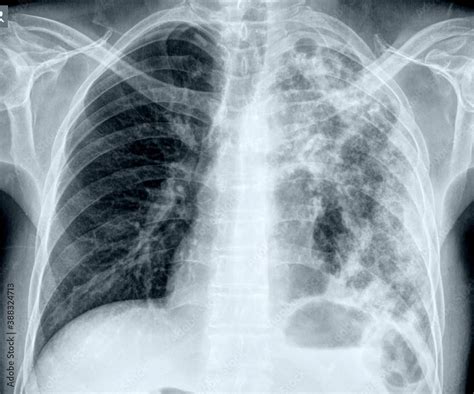 Radiograf A De T Rax Con Neumonia Complicada Y Atelectasia