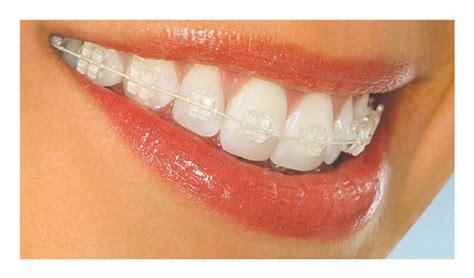 ortodontia  arte braquetes esteticos