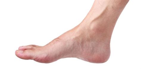 How To Get Rid Of A Ganglion Cyst On Your Foot Foot Healthcare Assoc