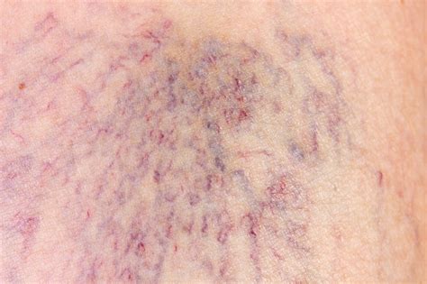 Spider Veins Explained Cause Symptoms And Treatment Veinsnet