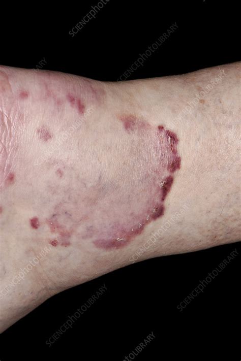 Ringworm Fungal Infection Stock Image C0401392 Science Photo Library