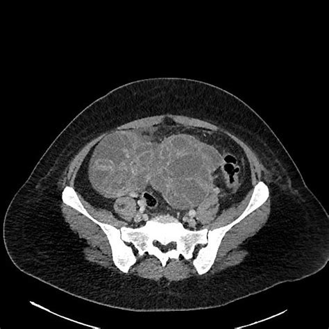 Ovarian Hyperstimulation Syndrome Radiology Captions Hunter