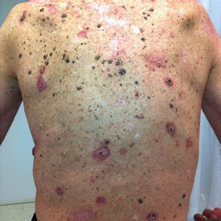 Dermoscopic Features Of Actinic Keratosis And Squamous Cell Carcinoma Download Scientific