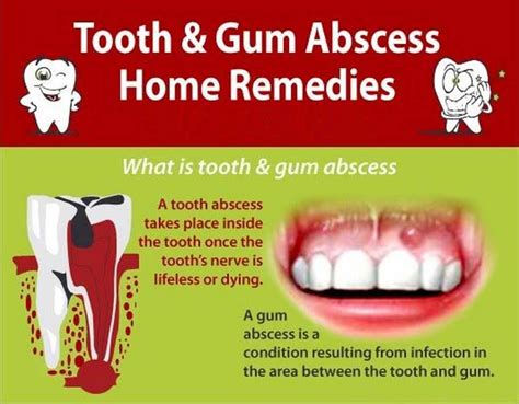 What To Do For Gum Abscess At Home