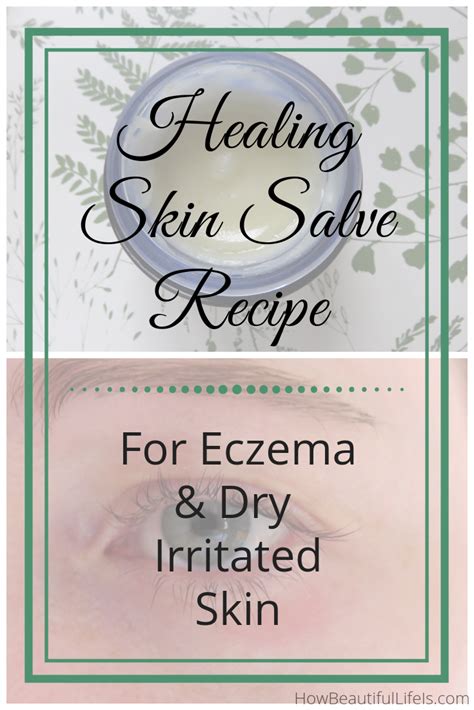 Natural Eczema Dry Skin Salve Recipe How Beautiful Life Is