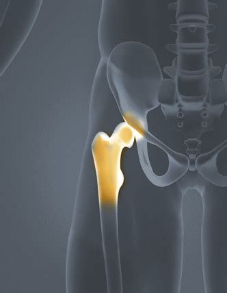 Dislocation of the hip joint. Hip - Where's Your Pain? - Kansas Spine & Specialty Hospital