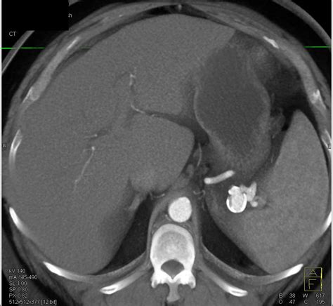 Calcified Splenic Artery Aneurysm Spleen Case Studies Ctisus Ct