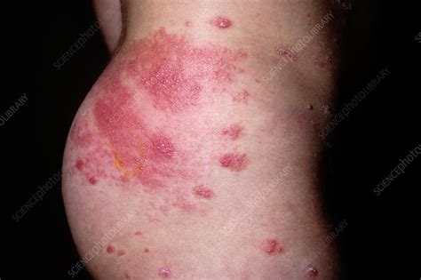 shingles rash on the buttock stock image c009 6839 science photo library