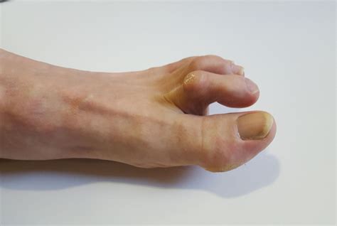 Pictures Of Arthritis In The Feet Signs Symptoms And Risk Factors