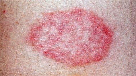 Leukemia Rash Pictures Signs And Symptoms Everyday Health