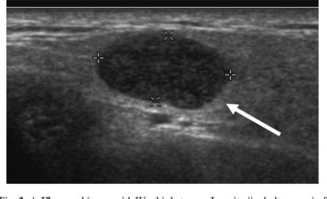 Figure 2 From Gray Scale And Color Doppler Ultrasonographic Features Of