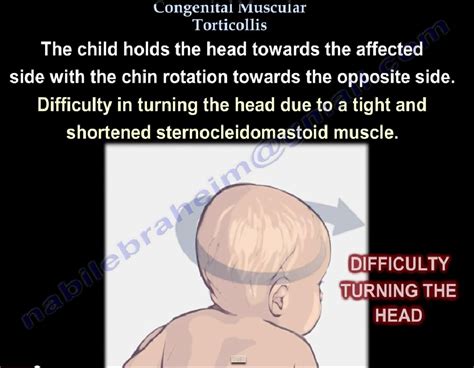 Congenital Muscular Torticollis —
