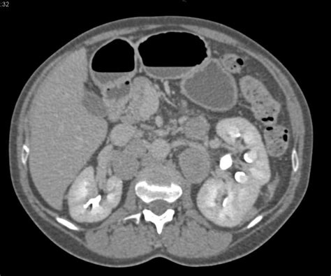 Cystic Renal Cell Carcinoma With Left Adrenal Metastases Adrenal Case