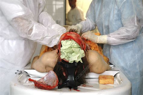 I am a district attorney in rural central texas who also wishes that more autopsies would be performed. Autopsy - Stock Image - C002/7277 - Science Photo Library