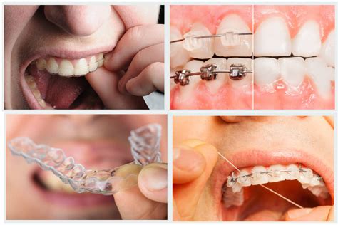You Can Improve Your Smile With Invisalign