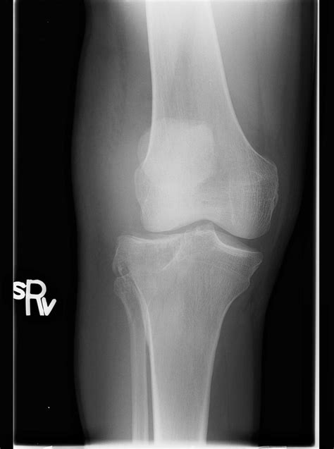 Radiograph Of The Right Knee Of A Patient Showing The Tibial Plateau