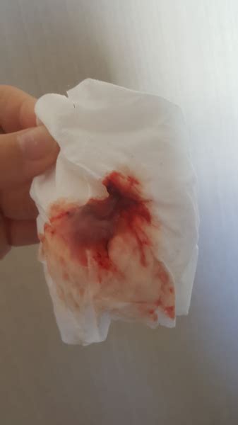 Spotting is light vaginal bleeding in pregnancy and often isn't problematic during the first trimester. Does this look like implantation bleeding? Sorry for tmi ...
