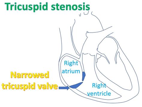 What Is Tricuspid Stenosis All About Heart And Blood Vessels