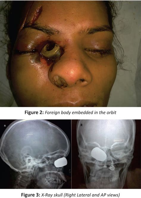 foreign body unusual retained orbital intraorbital superior removal djo