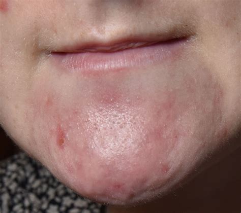 Acne These Bumps Like To Play Hide And Seekcan Anyone Help Me With