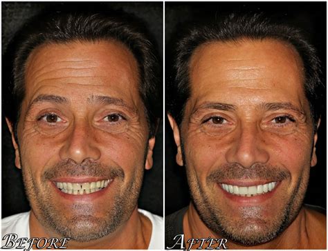 All On 4 Dental Implants Before And After Photos Center 4 Smiles