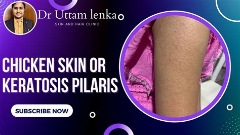 Chicken Skin Treatment Or Keratosis Pilaris Small Hard Bumps On Arm