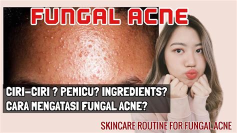 Bagaimana Cara Mengatasi Fungal Acne Skincare Yang Aman Untuk Fungal