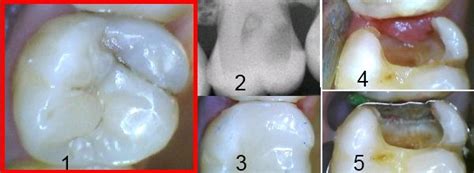 Bei der entfernung eines zahns (in der fachsprache zahnextraktion genannt) muss der zahnarzt. Selbsthilfen im Notfall,Empfehlungen zur Zahnpflege ...