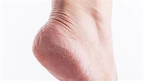 How To Fix Dry Cracked Feet Skin Hand Dry Skin On Feet Organic Skin